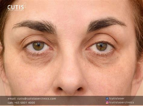 Address Or Correct Tear Trough Hollows With Fillers In Singapore