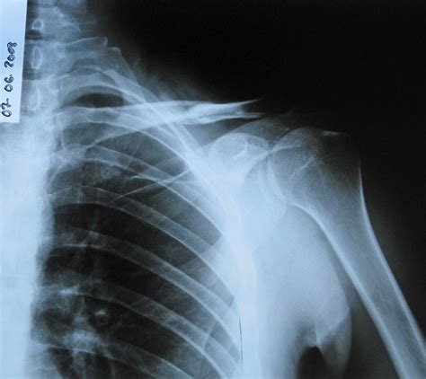How To Rehab A Collarbone After Surgery