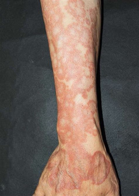 Asymptomatic Widespread Erythematous To Violaceous Papules And