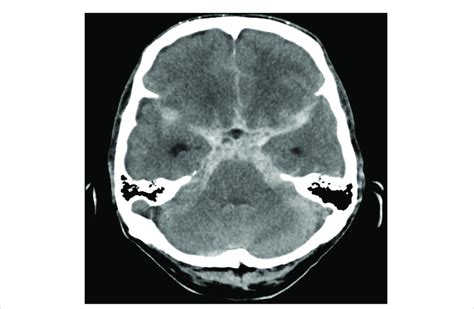 Computed Tomography Brain Showing Extensive Acute Subarachnoid
