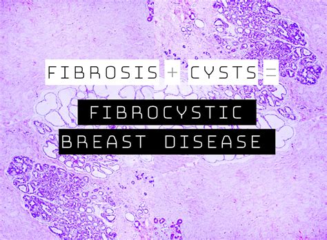 High Yield Breast Pathology Fibrocystic Changes