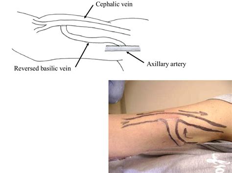 Primary Arteriovenous Fistula Inflow Proximalization For Patients At