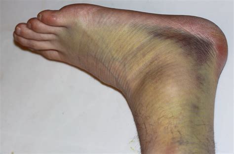 Severely Sprained Ankle Flickr Photo Sharing