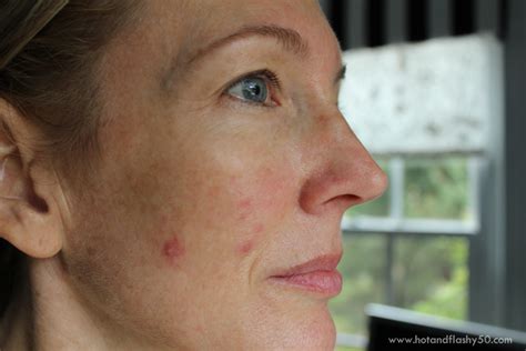 Menopause And Hormonal Acne