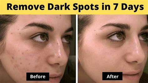 Top 10 Home Remedies How To Remove Dark Spots On Face Dark Spots On