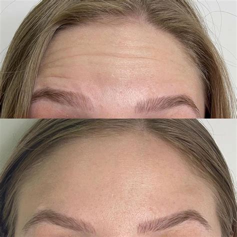 Botox Antes E Depois Em Fotos