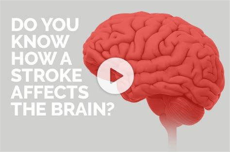 Do You Know How Suffering A Stroke Affects The Brain