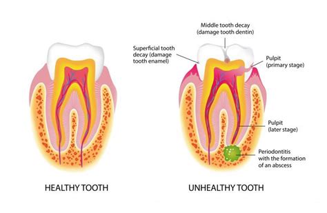 A root canal removes infected and inflamed dental pulp, essentially hollowing out your tooth (and sometimes removing much of the natural tooth material). Root Canal Morris County, NJ