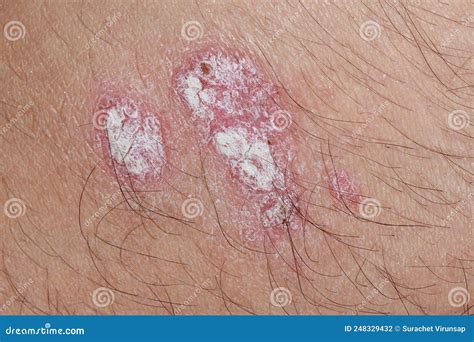 Psoriasis Is An Autoimmune Disease That Affects The Skin Causing Red