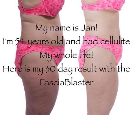 Keep On Blasting This Is A Real Client S Results After Only 2 Weeks Of Using The Fasciablaster
