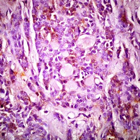 A Photomicrograph Of High Grade Adenoid Cystic Carcinoma Showing Few