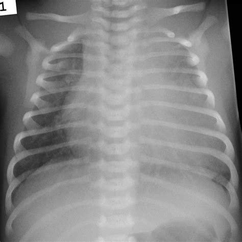 Utah Pediatric Radiology Case Of The Week Infant With Chf