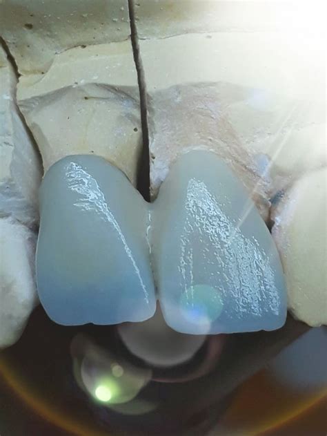 A dental bridge is used to bridge the gap between two healthy teeth where one or more teeth are missing. Cantilever bridge | Dental bridge cost, Dental bridge, Dental ceramics
