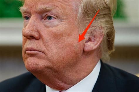 What Is That Spot On Donald Trumps Face Probably Keratosis
