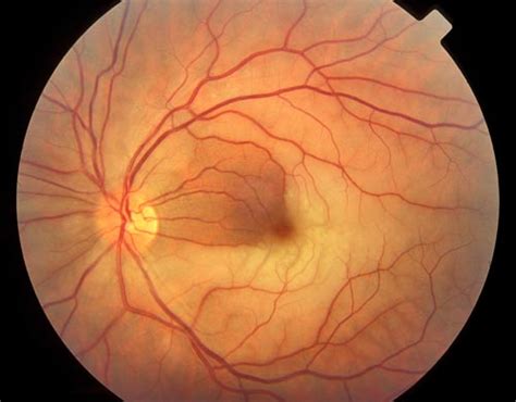 Retinal Artery And Vein Occlusion Health Plan Eyesight