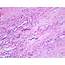 Pathology Outlines  Calciphylaxis
