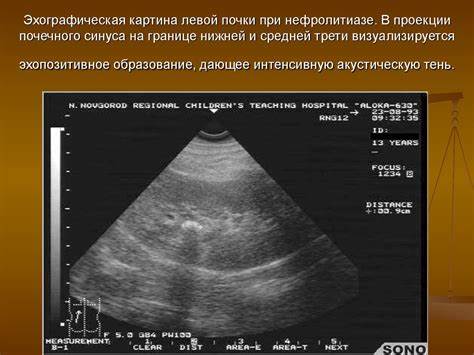 Диета при нефролитиазе у женщин