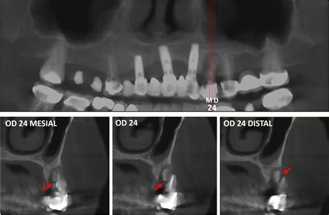 Fractura Vertical En Un Premolar Superior Con Endodoncia Dento Metric