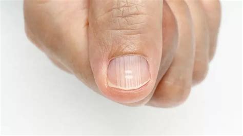Health Problems Your Fingernails Can Indicate From White Spots To