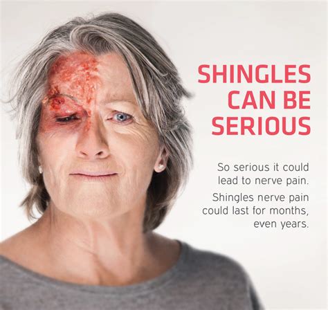 Pictures Of Shingles On Your Face Itiscouragethatcounts