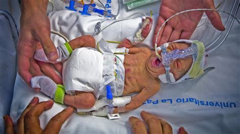 Premature Births ‘an Unrecognised Killer Channel 4 News