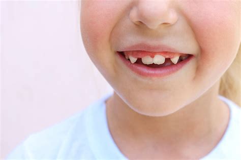 Child Crooked Teeth Kids Choice Dental
