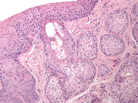 Sebaceous Gland Ectopia Of The Esophagus A Challenging Clinical