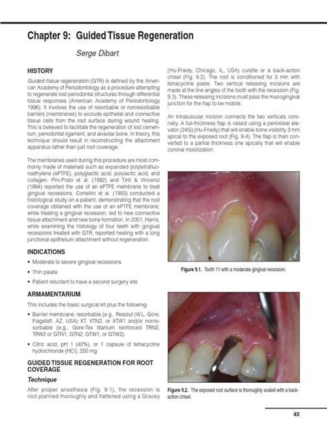 Guided Tissue Regeneration Dentistry Health Sciences