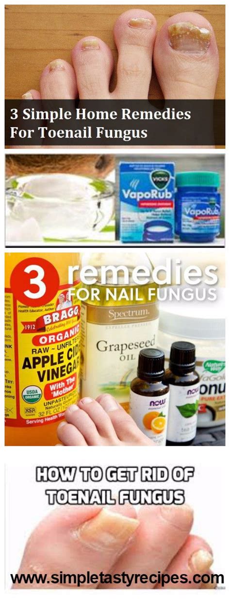 3 Simple Home Remedies For Toenail Fungus Health Blog