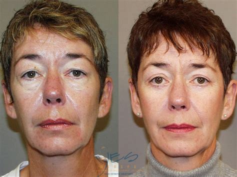 Lower Eyelid Blepharoplasty Before And After Photos Patient 45 Langley