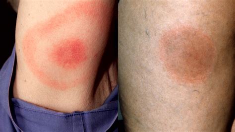 Types Of Rashes That Can Be Signs Of Lyme Disease Lyme Disease My XXX Hot Girl