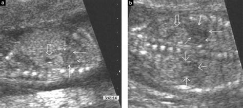 Enlarged Adrenal Glands As A Prenatal Marker Of Congenital Adrenal
