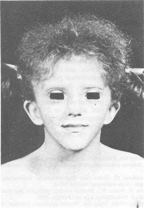 Figure 2 From Noonan Syndrome Fig 4 An Adolescent With Noonan Syndrome Semantic Scholar