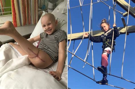 Girl Beats Bone Cancer By Having Leg Removed Reattached Backward