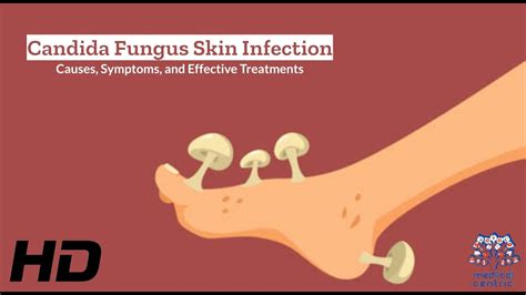 Candida Fungus Skin Infection Explained What You Need To Know Youtube