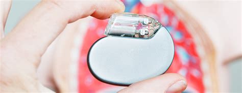 Implantable Cardioverter Defibrillator Conditions And Treatments Ucsf