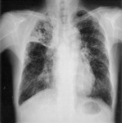 Figure 3 From Chronic Necrotizing Pulmonary Aspergillosis Complicated