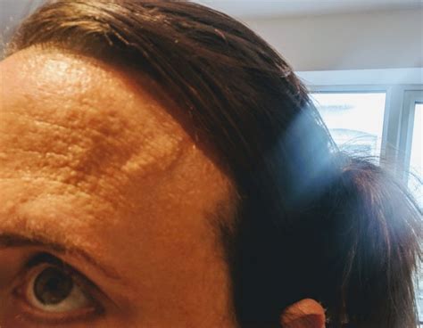 Awful Orange Peel Skin On Forehead Help Pic Attached Mumsnet