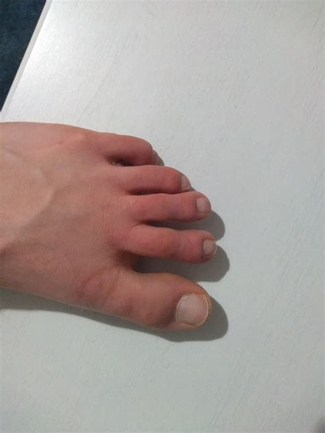 Most Toes Get Red Itchy Tingly Usually Happens Late At Night And