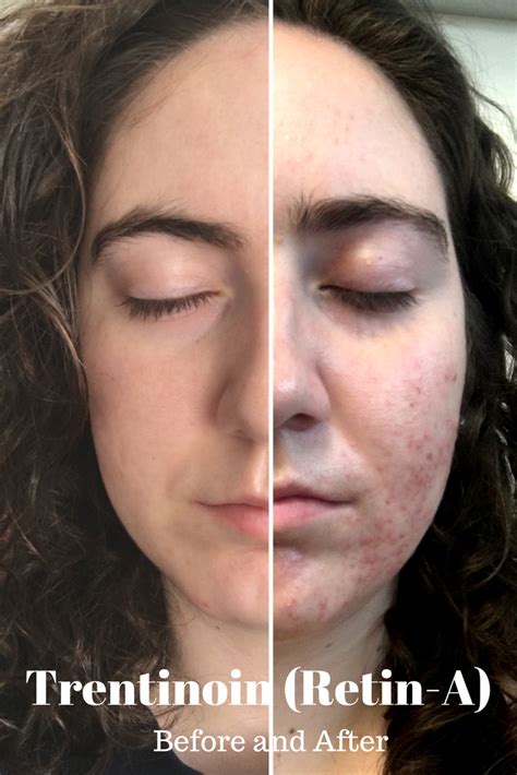Tretinoin Retin A Before And After Acne Before And After Acne