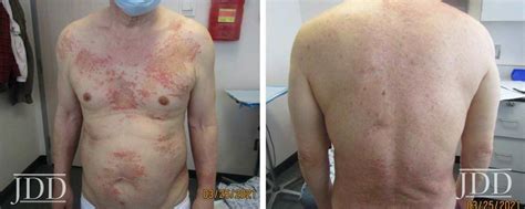 Dermal Hypersensitivity Reaction To Semaglutide Two Case Reports