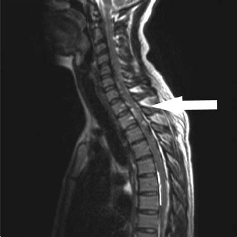 Sagittal T2 Weighted Mri Of The Cervical And Thoracic Spine Taken 5