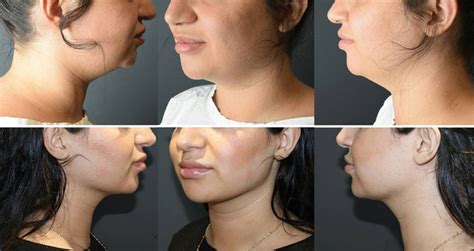 Fixing A Weak Jawline With Cosmetic Surgery Cosmos Aesthetics