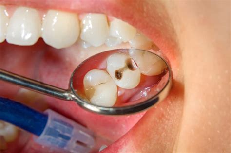 If you think you have a cavity, you should make an appointment with your dentist immediately. How to Tell if You Have a Cavity | Gables Sedation
