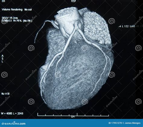 Ct Scan 3d Heart Angiography Colorful Royalty Free Stock Image