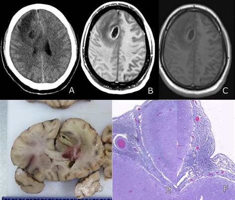 Sudden Death From Rupture Of Cerebral Abscess Into Subarachnoid Space