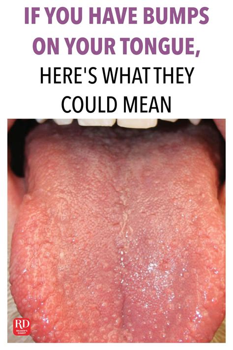 if you have bumps on your tongue here s what they could mean tongue health bumps on tongue