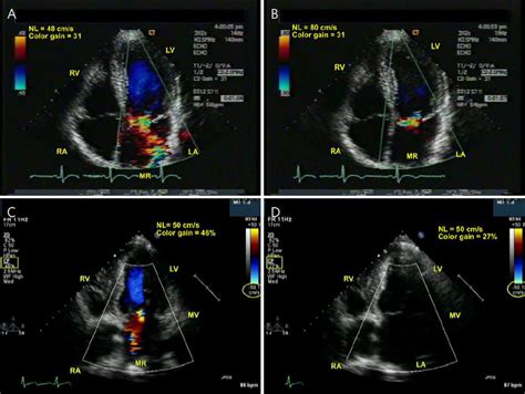 Two Dimensional Transthoracic Echocardiography Apical Four Chamber