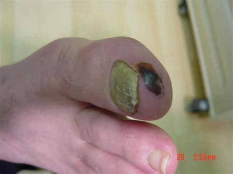 These organisms are part of the fungal kingdom, which includes mushrooms and fungi flourish in a warm, moist environment—and that certainly describes the groin. Fungal Infections - The Skin Center: Board-Certified ...