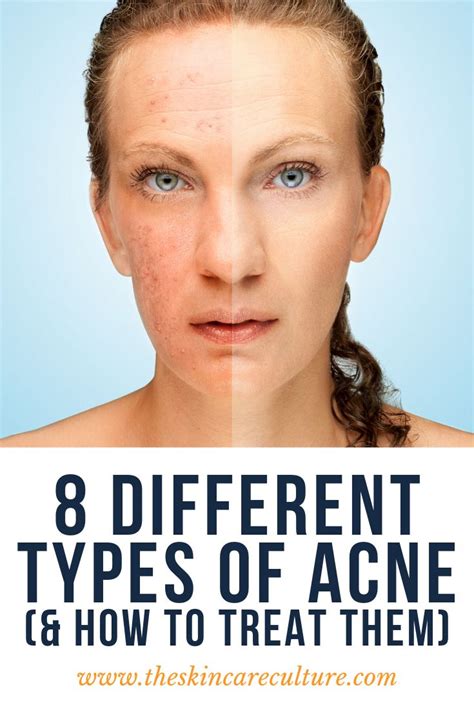 8 Different Types Of Acne With Pictures Types Of Acne Different